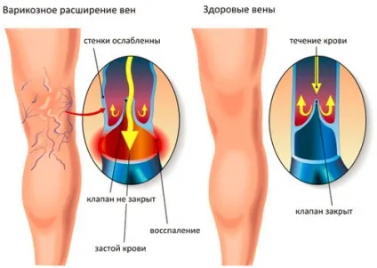 Судоми в ногах причини і лікування медикаментами, заходи профілактики (причини) Судоми в ногах причини і лікування медикаментами, заходи профілактики
