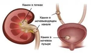 Уролитиаз у чоловіків, симптоми сечокам'яної хвороби і лікування уролітіазу у чоловіків (чоловіків) Уролитиаз у чоловіків, симптоми сечокам'яної хвороби і лікування уролітіазу у чоловіків