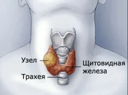 Вузли щитовидної залози (вузли) Вузли щитовидної залози