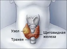 Вузловий зоб, щитовидні вузли (вузловий) Вузловий зоб, щитовидні вузли