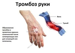 Варикоз на руках - симптоми, причини і лікування (причини) Варикоз на руках - симптоми, причини і лікування