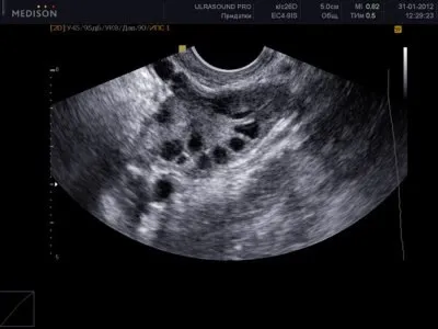 Узі яєчників нормальні розміри, як роблять (розміри) Узі яєчників нормальні розміри, як роблять