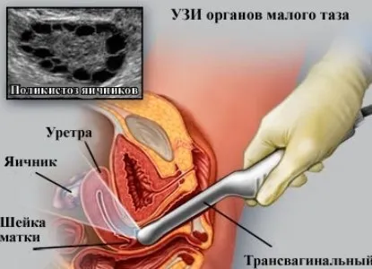 Узі яєчників нормальні розміри, як роблять (органів малого таза) Узі яєчників нормальні розміри, як роблять