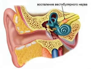 Вестибулярний нейронів симптоми і лікування (симптоми) Вестибулярний нейронів симптоми і лікування