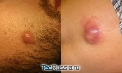Види новоутворень на шкірі, обличчі і тілі - фото і коментарі (tecrussia) Види новоутворень на шкірі, обличчі і тілі - фото і коментарі