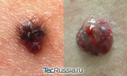 Види новоутворень на шкірі, обличчі і тілі - фото і коментарі (види) Види новоутворень на шкірі, обличчі і тілі - фото і коментарі