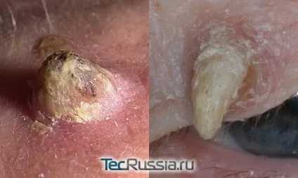 Види новоутворень на шкірі, обличчі і тілі - фото і коментарі (новоутворень) Види новоутворень на шкірі, обличчі і тілі - фото і коментарі