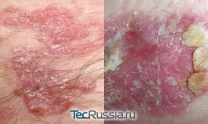 Види новоутворень на шкірі, обличчі і тілі - фото і коментарі (питання) Види новоутворень на шкірі, обличчі і тілі - фото і коментарі