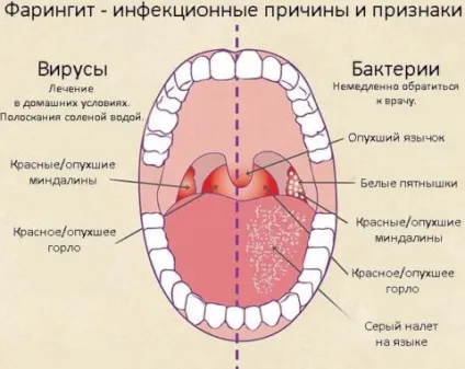Вірусний фарингіт сучасні підходи до лікування (сучасні) Вірусний фарингіт сучасні підходи до лікування