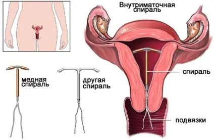 Внутрішньоматкові спіралі (вмс) принципи використання