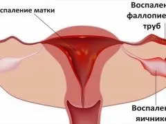 Запалення правого яєчника, симптоми, причини і принципи лікування (симптоми) Запалення правого яєчника, симптоми, причини і принципи лікування