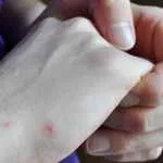 Яблучний оцет при судинних зірочках - лікування і використання (зірочках) Яблучний оцет при судинних зірочках - лікування і використання