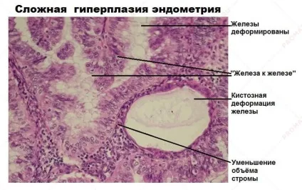 Залозиста гіперплазія ендометрію - лікування, симптоми (ендометрія) Залозиста гіперплазія ендометрію - лікування, симптоми