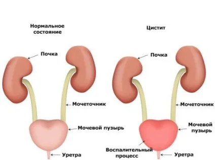 Утруднення сечовиділення у чоловіків і жінок причини, лікування (утруднене) Утруднення сечовиділення у чоловіків і жінок причини, лікування