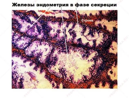 Залозиста гіперплазія ендометрію - лікування, симптоми (залозиста) Залозиста гіперплазія ендометрію - лікування, симптоми