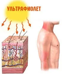 Алергія на сонце - фотодерматит