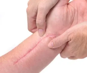 Як прибрати шрами на руці, світ жінки (руці) Як прибрати шрами на руці, світ жінки