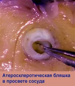 Артеріосклероз симптоми, лікування, самостійні дії (артеріосклероз) Артеріосклероз симптоми, лікування, самостійні дії