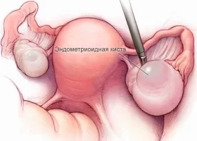 Арахноідальная і церебральна кіста головного мозку (мозкового) Арахноідальная і церебральна кіста головного мозку