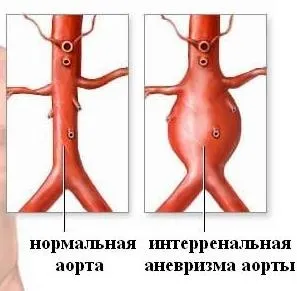 Аневризма аорти причини, симптоми і лікування (діагностована аневризма аорти) Аневризма аорти причини, симптоми і лікування