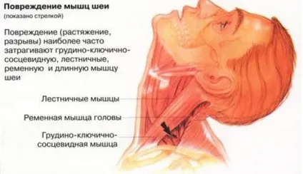 Болить шия і потилицю, причини болю ззаду, лікування, чому, від чого (лікування) Болить шия і потилицю, причини болю ззаду, лікування, чому, від чого