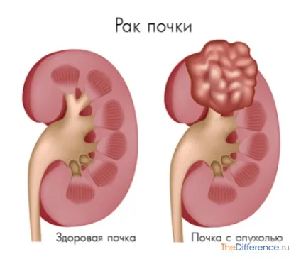 Чим відрізняється кіста від пухлини (пухлини) Чим відрізняється кіста від пухлини