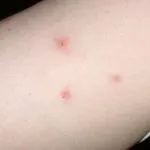 Що робити якщо покусали клопи основні симптоми і фото (покусали) Що робити якщо покусали клопи основні симптоми і фото
