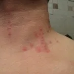 Що робити якщо покусали клопи основні симптоми і фото (клопи) Що робити якщо покусали клопи основні симптоми і фото