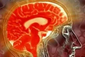Дисциркуляторна енцефалопатія замісної зовнішньої гідроцефалії (гідроцефалії) Дисциркуляторна енцефалопатія замісної зовнішньої гідроцефалії