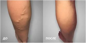 Ектазія яремної вени справа лікування, лікування вен (Cream varicose veins) Ектазія яремної вени справа лікування, лікування вен