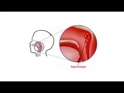 Фізіотерапія при аденоїдах у дітей