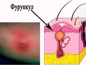 Фурункул на шиї як лікувати гнійне запалення (фурункул) Фурункул на шиї як лікувати гнійне запалення