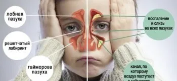 Грибковий гайморит симптоми, лікування захворювання і профілактика (гайморит) Грибковий гайморит симптоми, лікування захворювання і профілактика