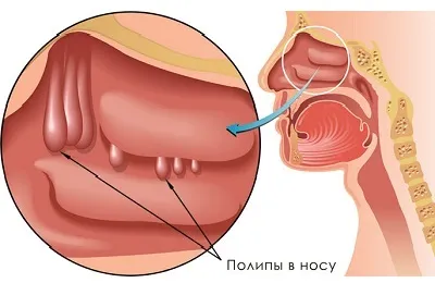 Грибковий гайморит симптоми, лікування захворювання і профілактика (захворювання) Грибковий гайморит симптоми, лікування захворювання і профілактика