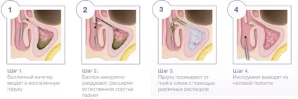 Грибковий гайморит симптоми, лікування захворювання і профілактика (грибковий) Грибковий гайморит симптоми, лікування захворювання і профілактика