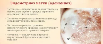 Індінол і епігаллат при ендометріозі фото і відгуки (Індінол) Індінол і епігаллат при ендометріозі фото і відгуки