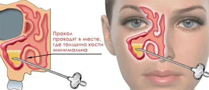 Грибковий гайморит симптоми, лікування захворювання і профілактика