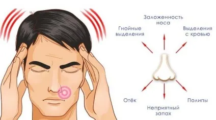 Грибковий гайморит симптоми, лікування захворювання і профілактика (лікування) Грибковий гайморит симптоми, лікування захворювання і профілактика