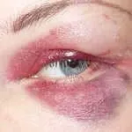 Як швидко позбутися від синців під очима в домашніх умовах (очима) Як швидко позбутися від синців під очима в домашніх умовах