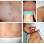 Які хвороби переносять клопи (хвороби переносять клопи) Які хвороби переносять клопи