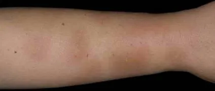 Яка алергічна реакція у вас була і на що (яка) Яка алергічна реакція у вас була і на що