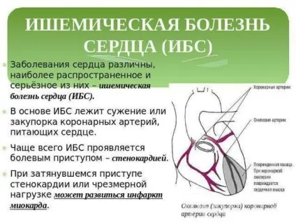 Ішемічна хвороба серця (ІХС) - що це таке і чим її лікувати (серця) Ішемічна хвороба серця (ІХС) - що це таке і чим її лікувати
