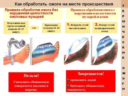 Як обробити опіки на місці події - презентація 89961-25