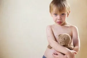 Як прискорити одужання при вітрянці - запитай лікаря (ознаки вітрянки дітей) Як прискорити одужання при вітрянці - запитай лікаря