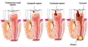Карієс цементу і кореня зуба лікування (карієс) Карієс цементу і кореня зуба лікування