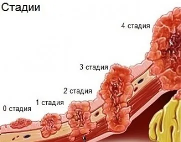 Карцинома шлунка симптоми, лікування, прогноз (прогноз) Карцинома шлунка симптоми, лікування, прогноз