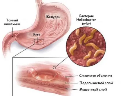 Карцинома шлунка симптоми, лікування, прогноз (прогноз) Карцинома шлунка симптоми, лікування, прогноз