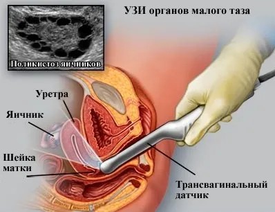 Кіста яєчника - причини, симптоми і лікування пухлини, профілактика захворювання (яєчника) Кіста яєчника - причини, симптоми і лікування пухлини, профілактика захворювання