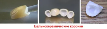 Керамічні коронки (безметалове протезування) установка, ціни, етапи виготовлення, фото до і (безметалове) Керамічні коронки (безметалове протезування) установка, ціни, етапи виготовлення, фото до і