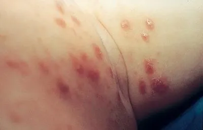 Як виглядає короста у людини симптоми і ознаки, як розпізнати в домашніх умовах (ознаки) Як виглядає короста у людини симптоми і ознаки, як розпізнати в домашніх умовах